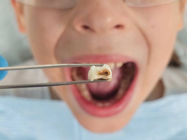 Best Emergency Tooth Extraction in Opelika, AL